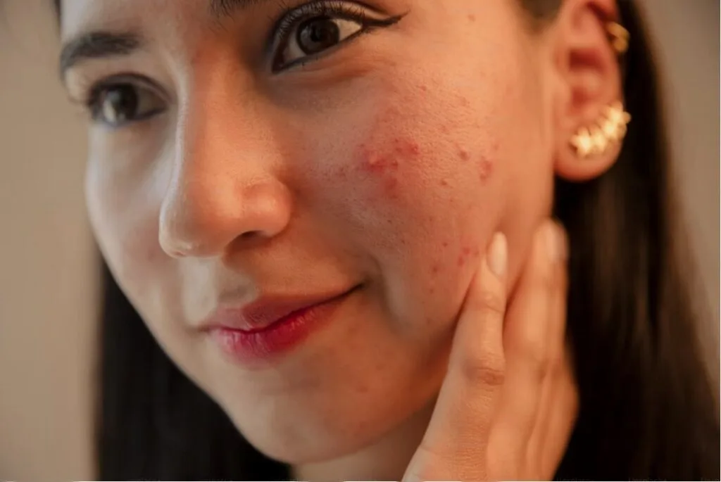 Clinique Acne Solutions Foundation Clinique Acne Solutions Foundation